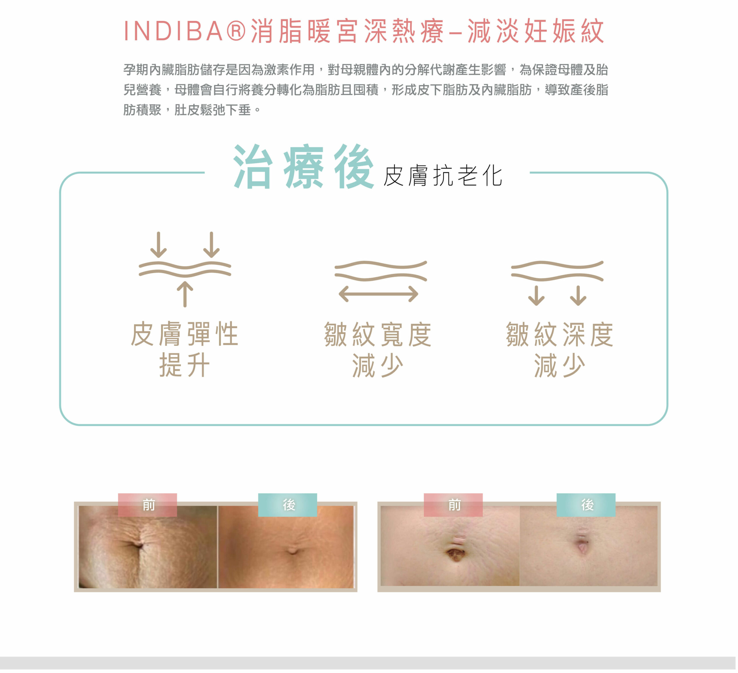 indiba