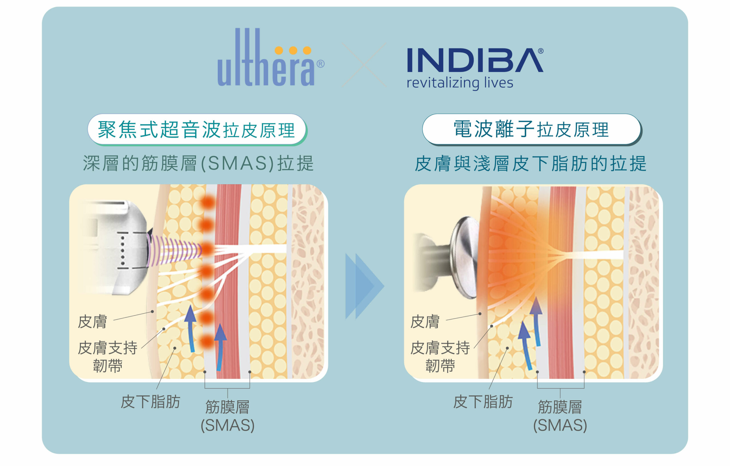ulthera