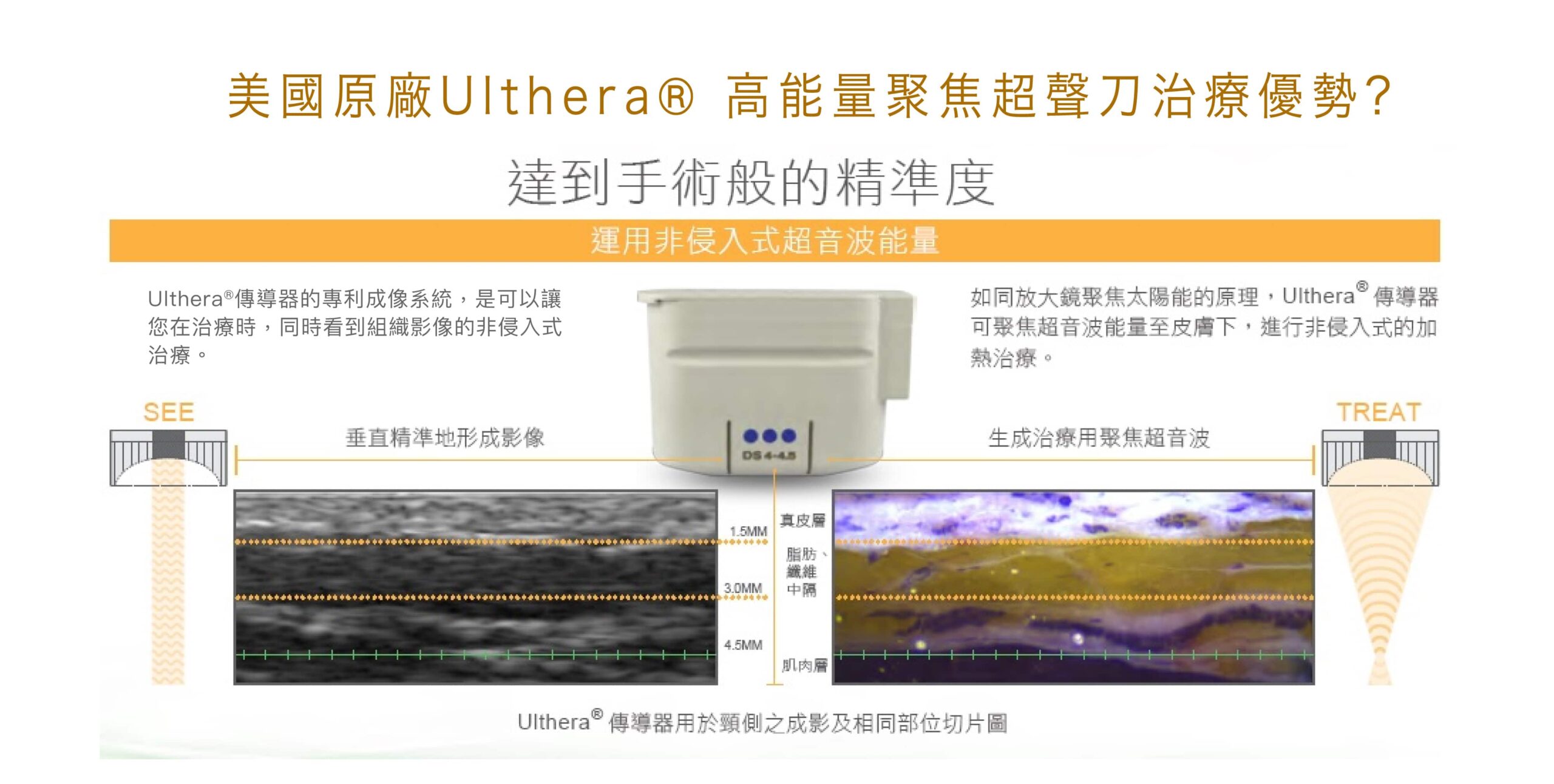 ulthera