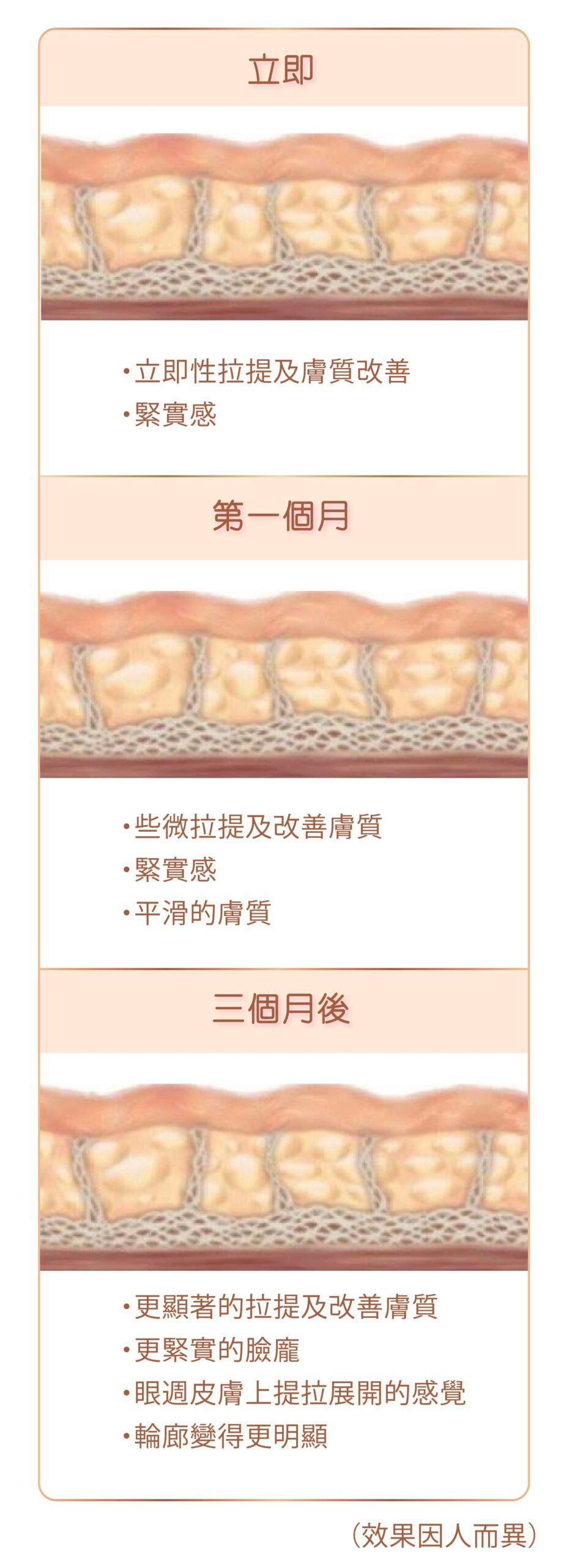 ulthera