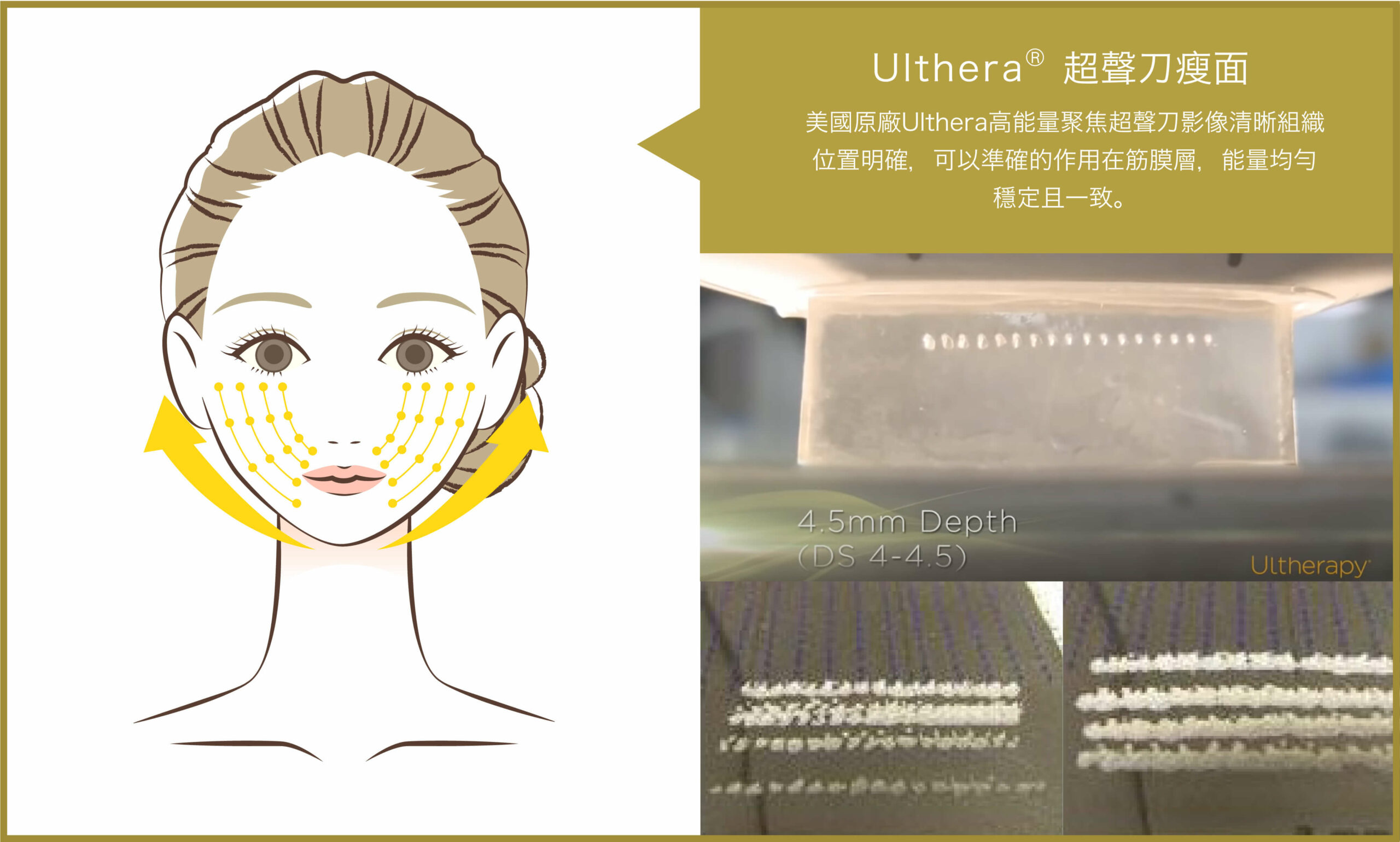 ulthera