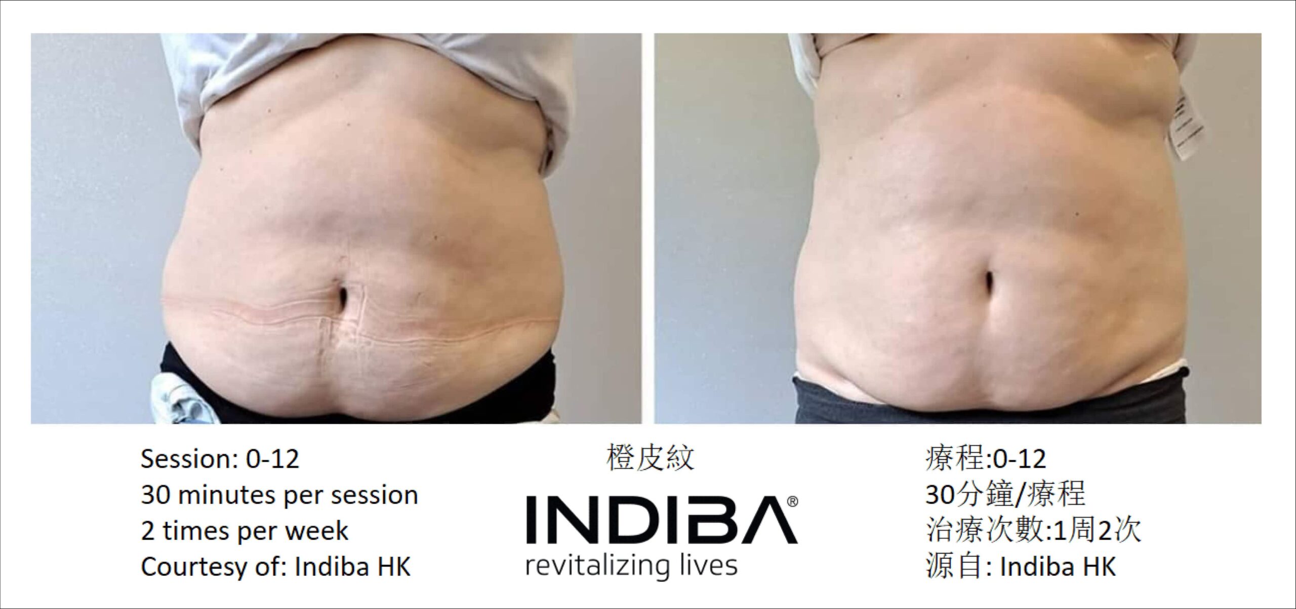 indiba_compare-02