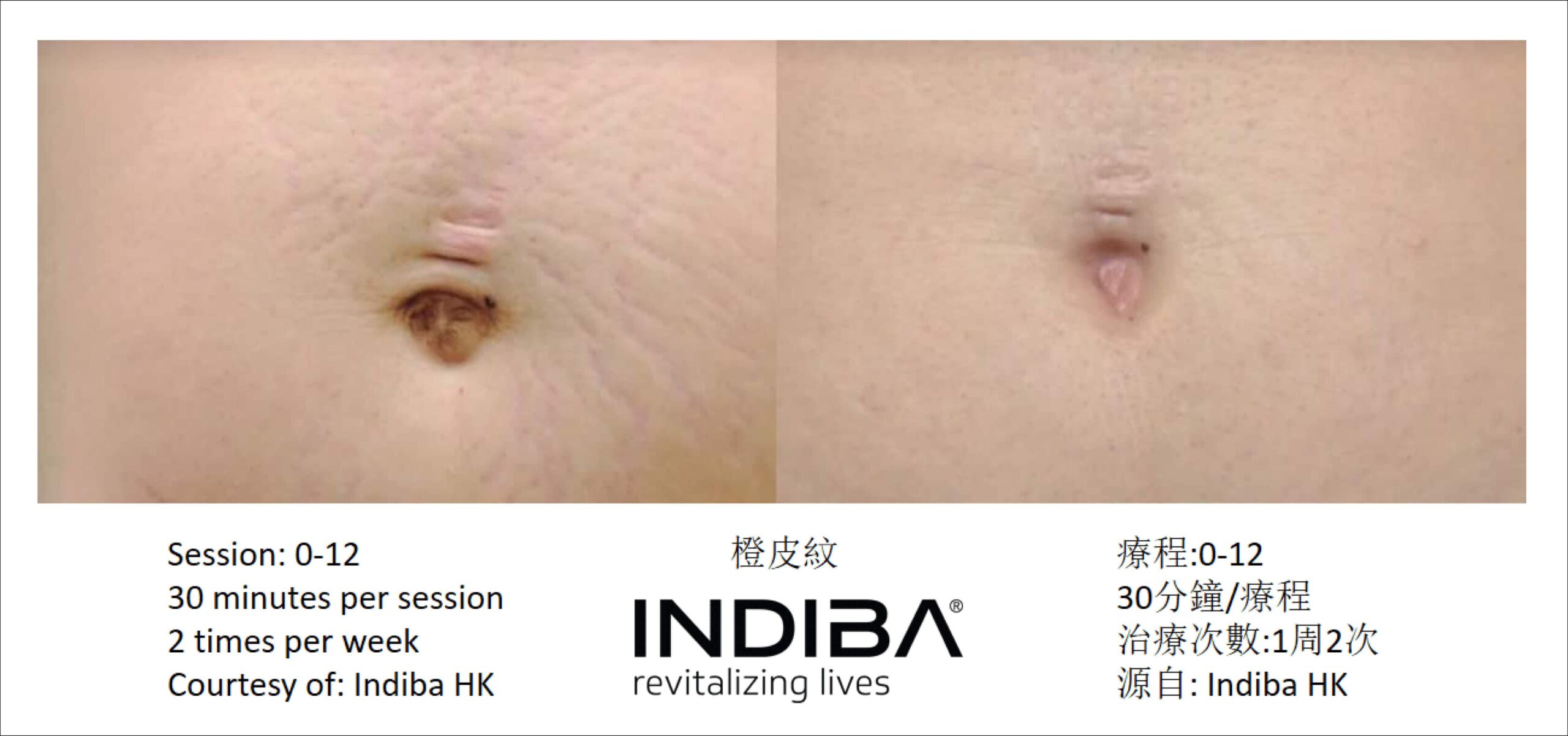 indiba_compare-03