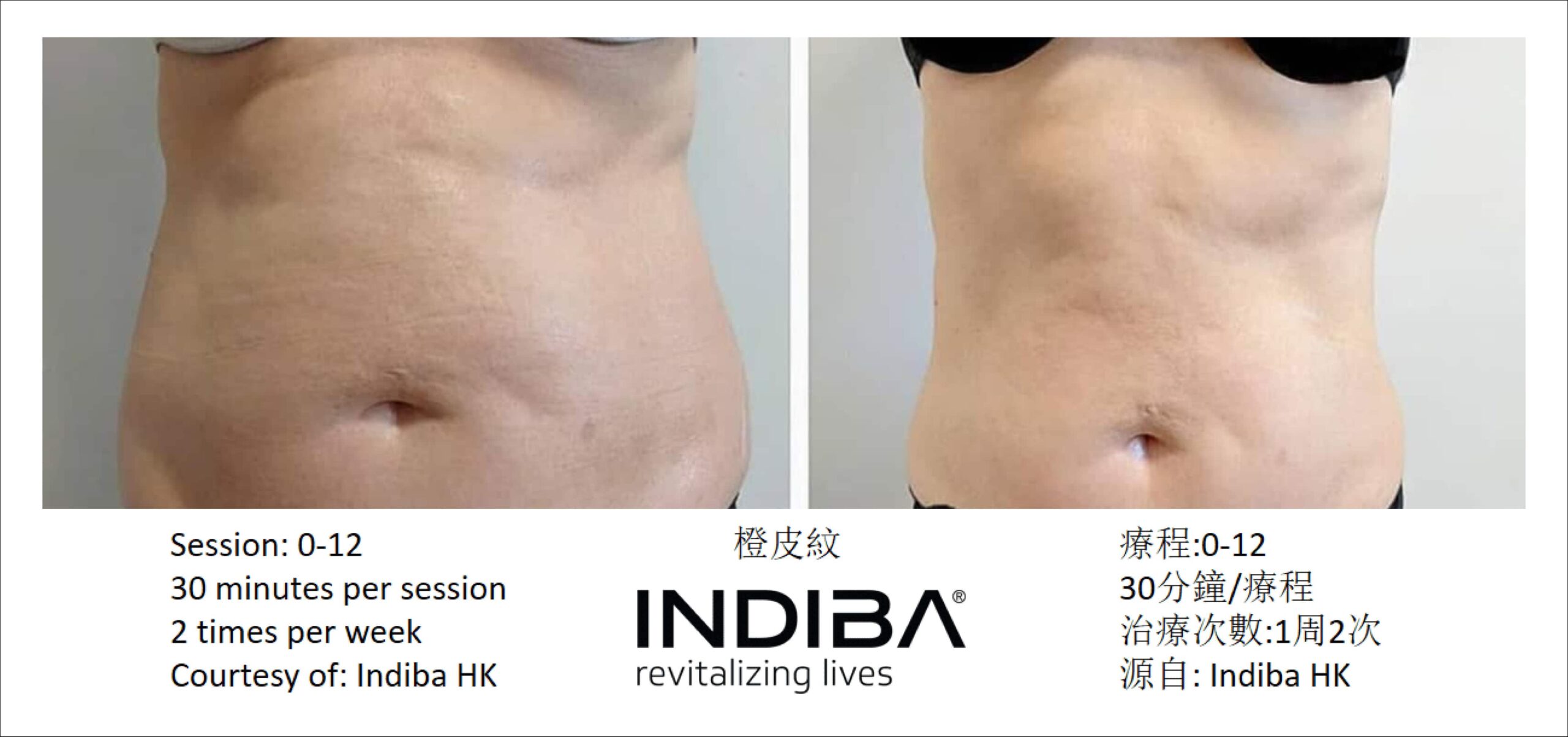 indiba_compare-04