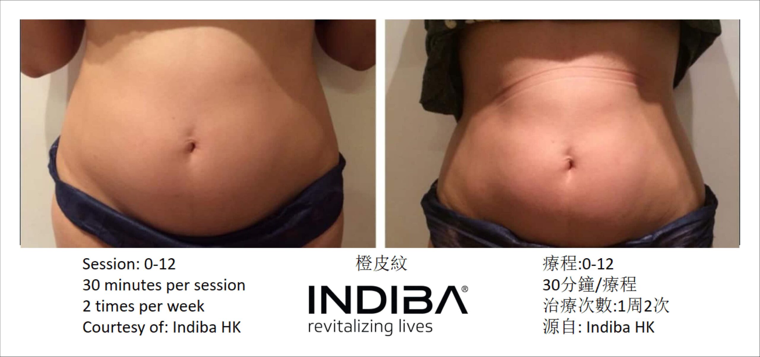 indiba_compare-05