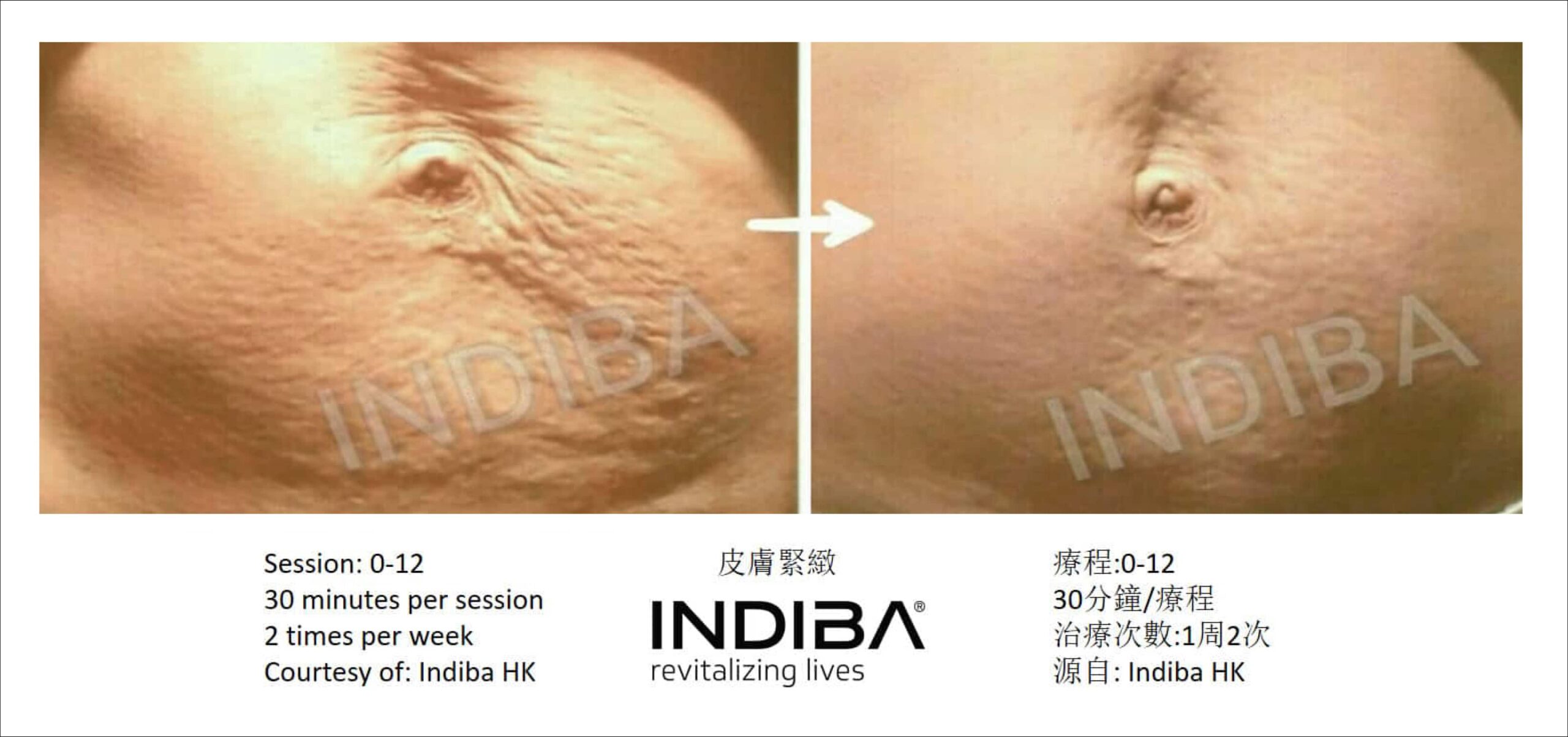 indiba_compare-11