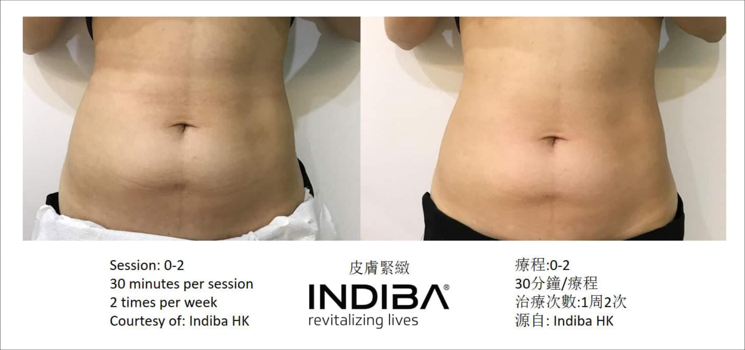 indiba_compare-12