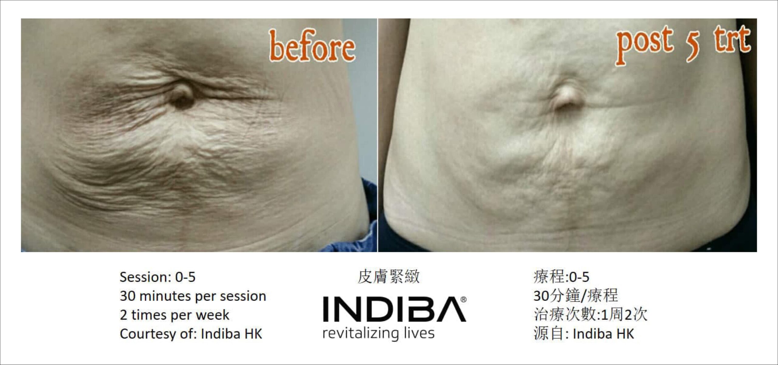 indiba_compare-13