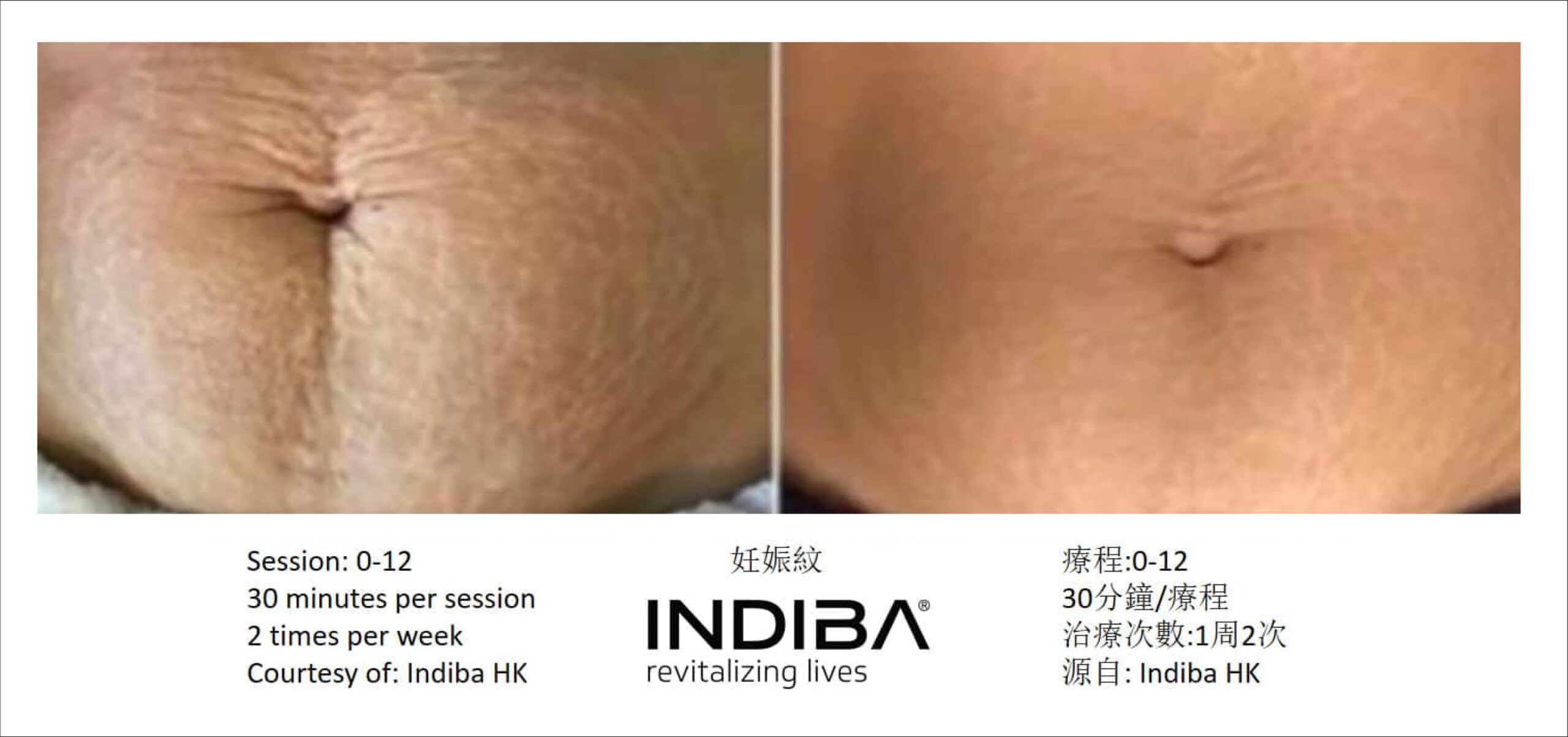 indiba_compare-14