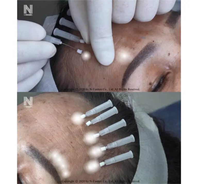 thread_lifting