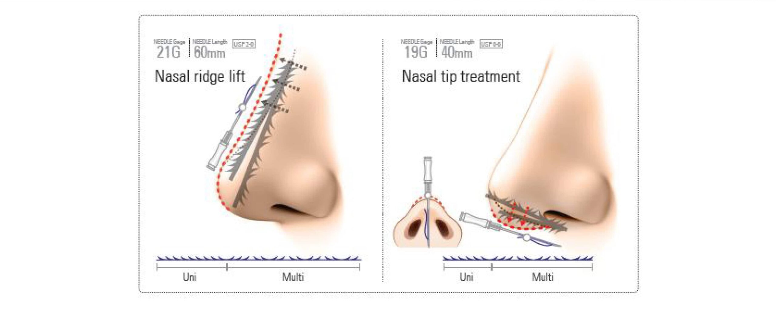 thread_lifting