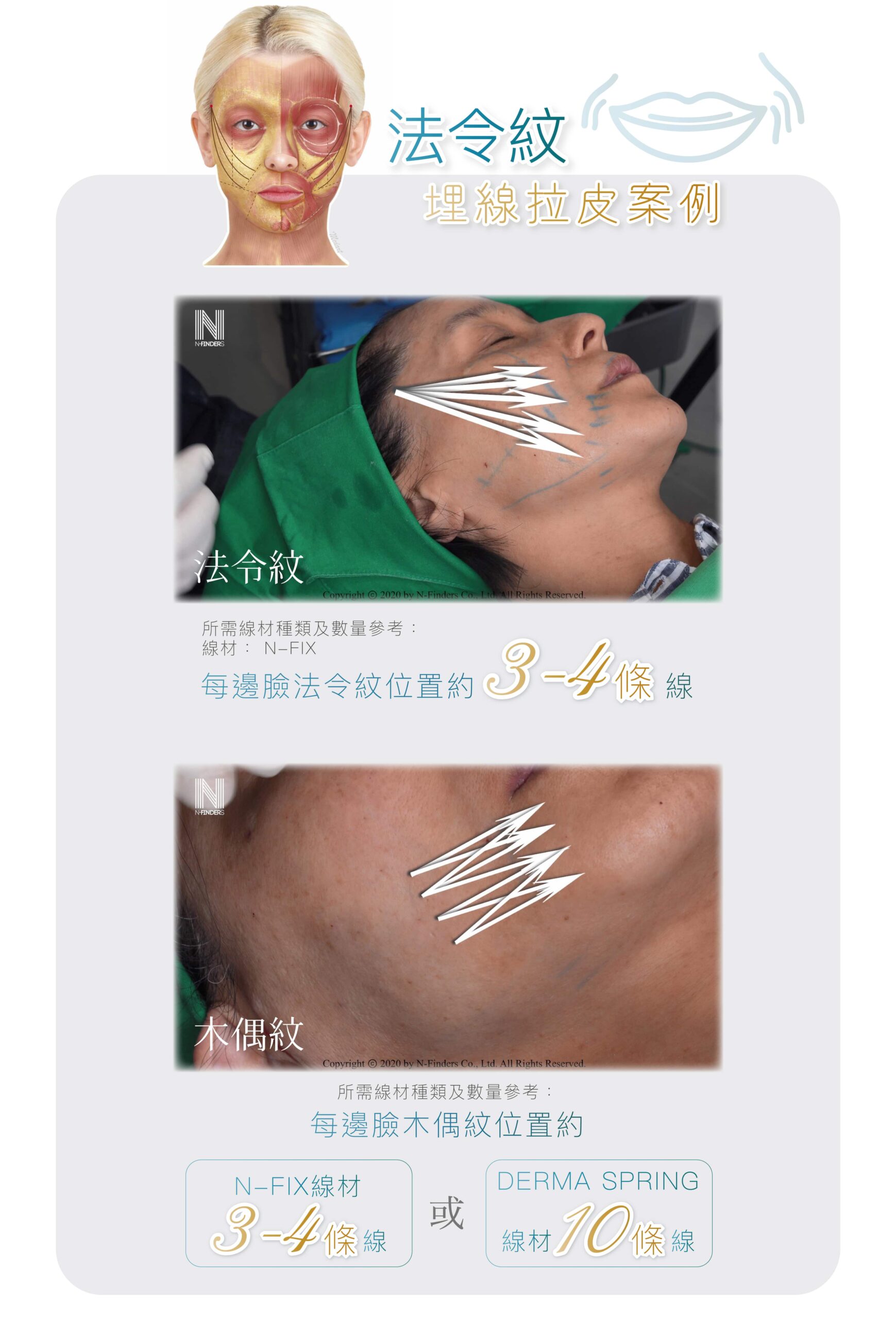 thread_lifting