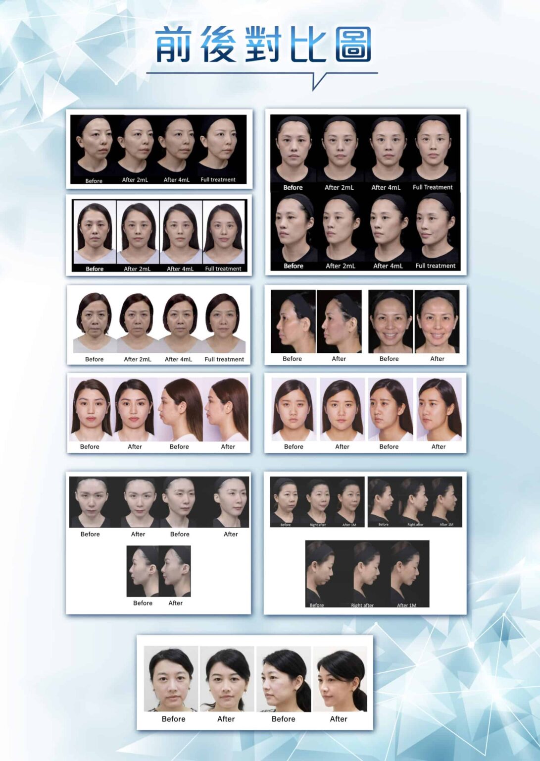 juvederm-3