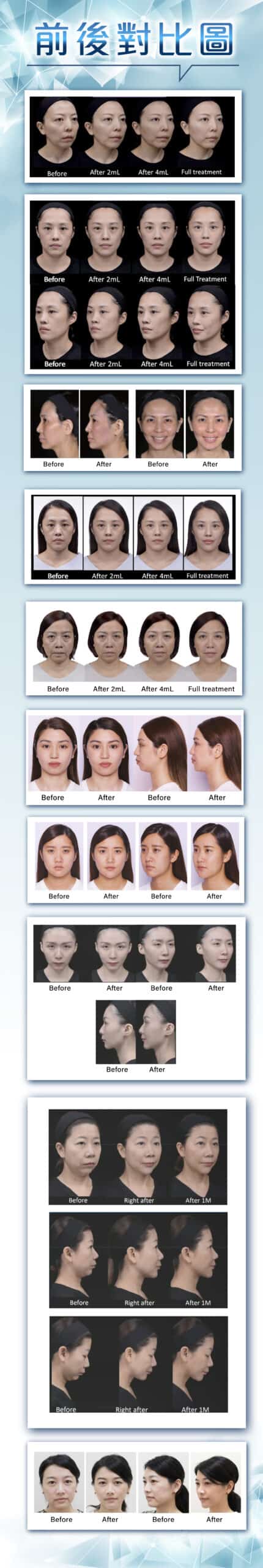juvederm-3