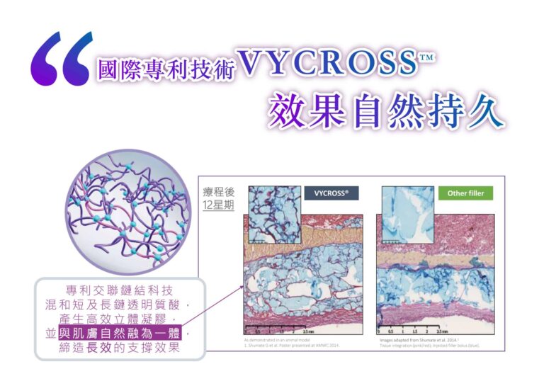 juvederm-3