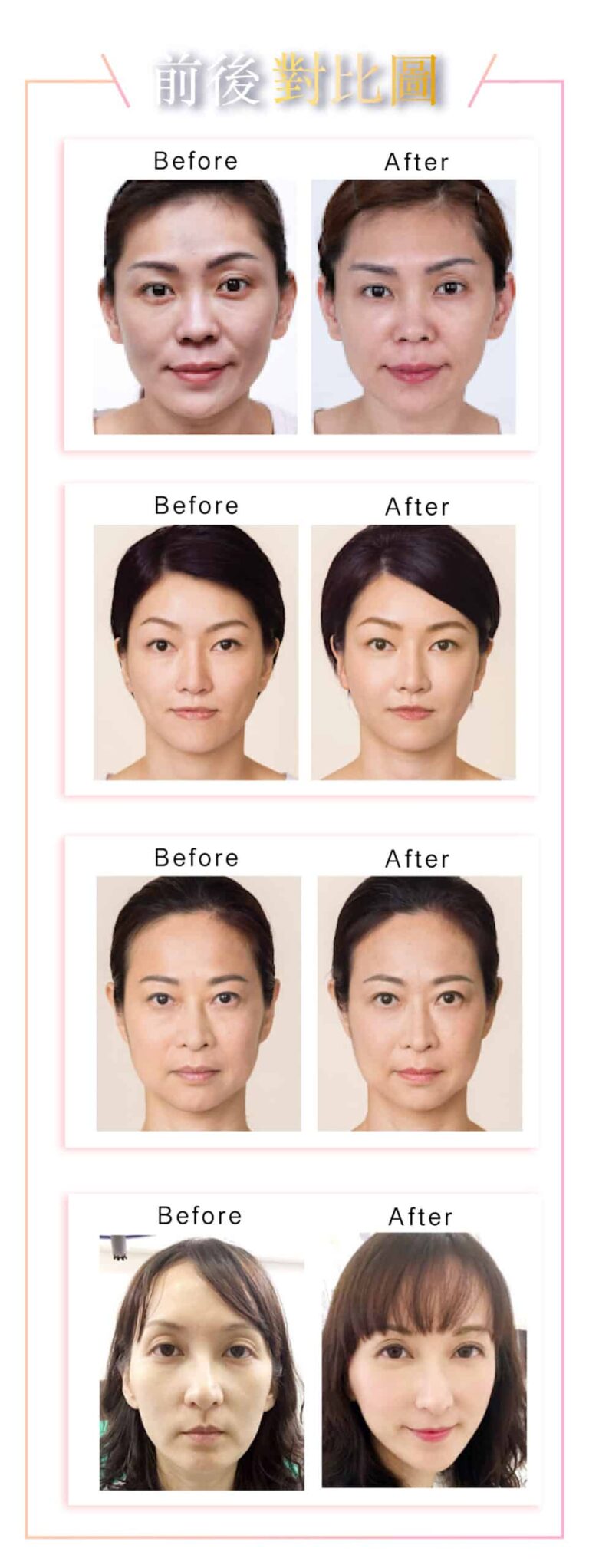 sculptra_and_derma_veil