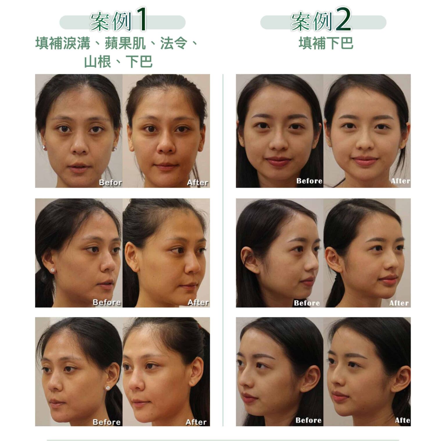 restylane_vs_juvederm