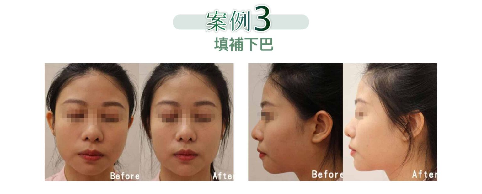restylane_vs_juvederm