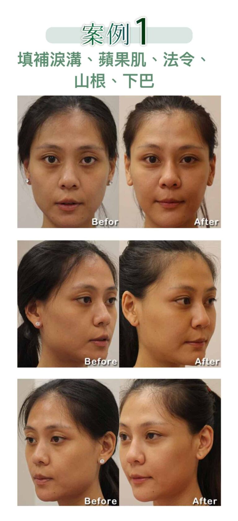 restylane_vs_juvederm