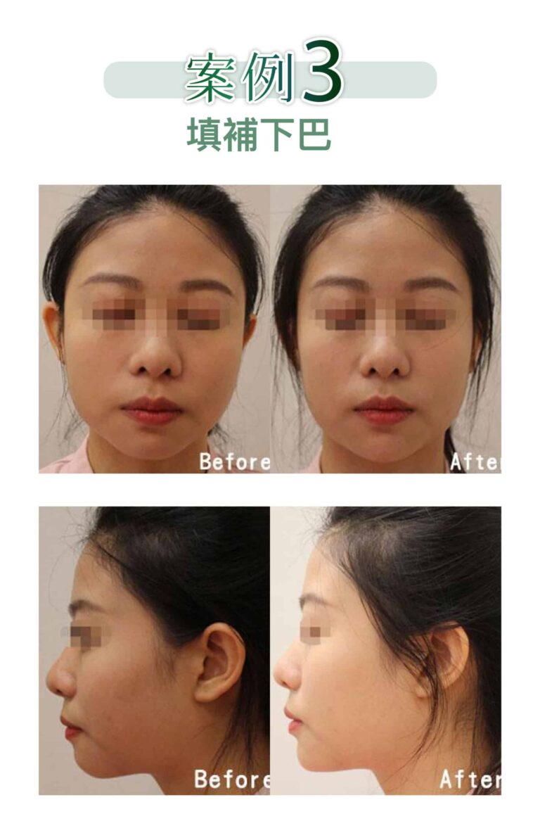 restylane_vs_juvederm