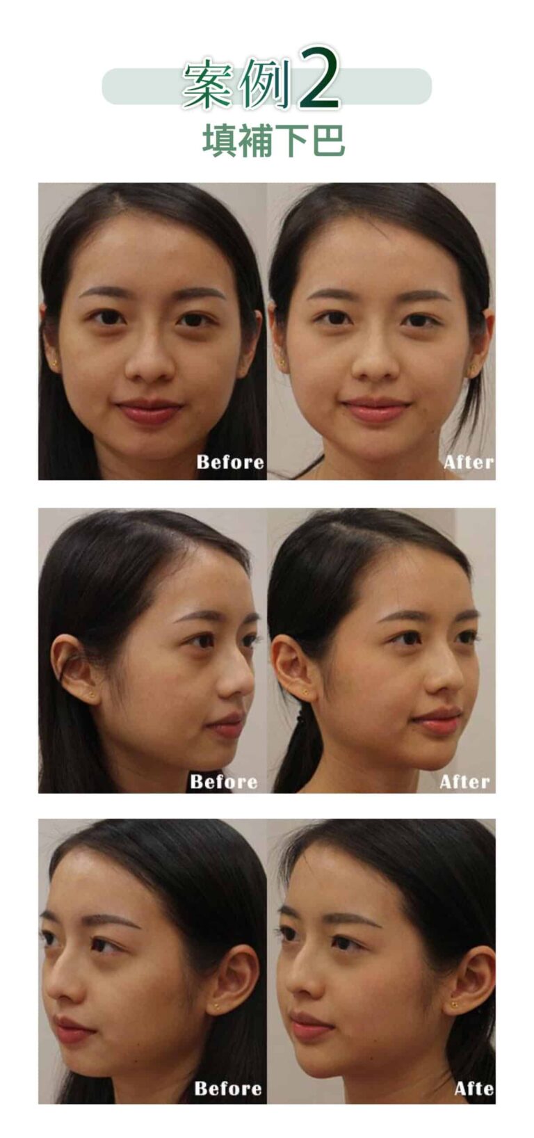 restylane_vs_juvederm