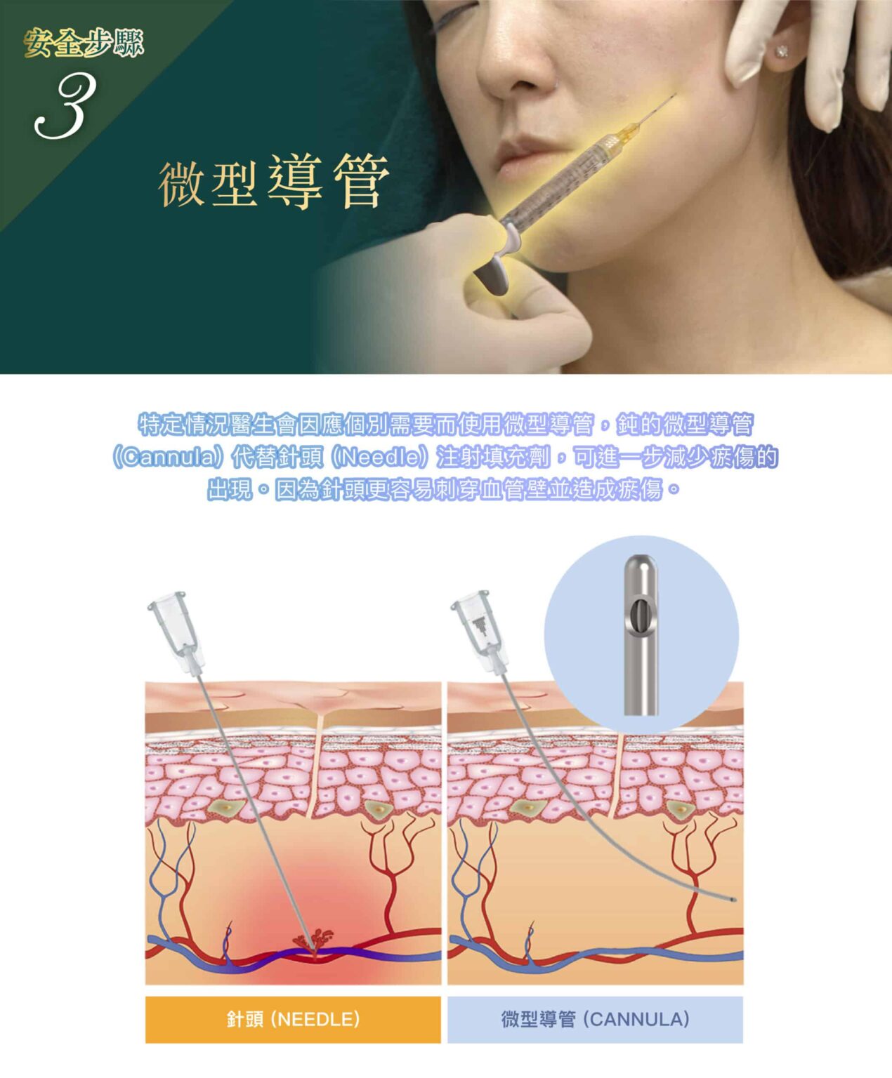 restylane