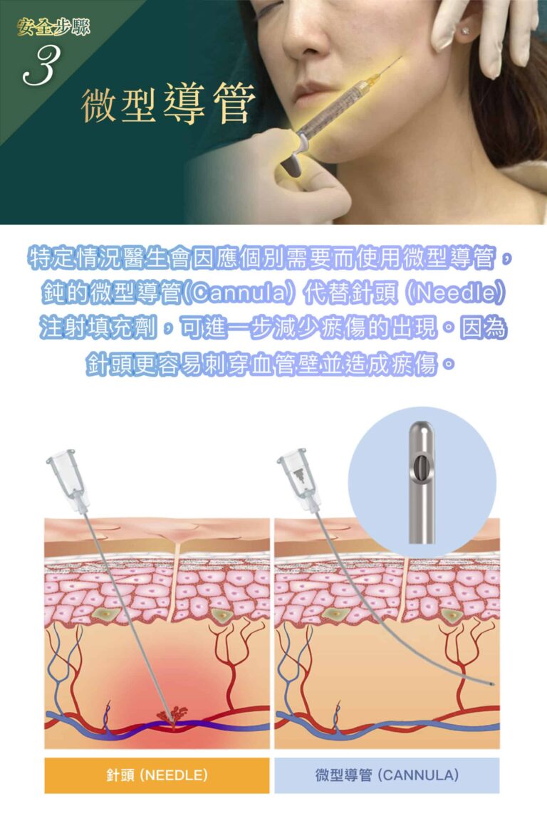 restylane