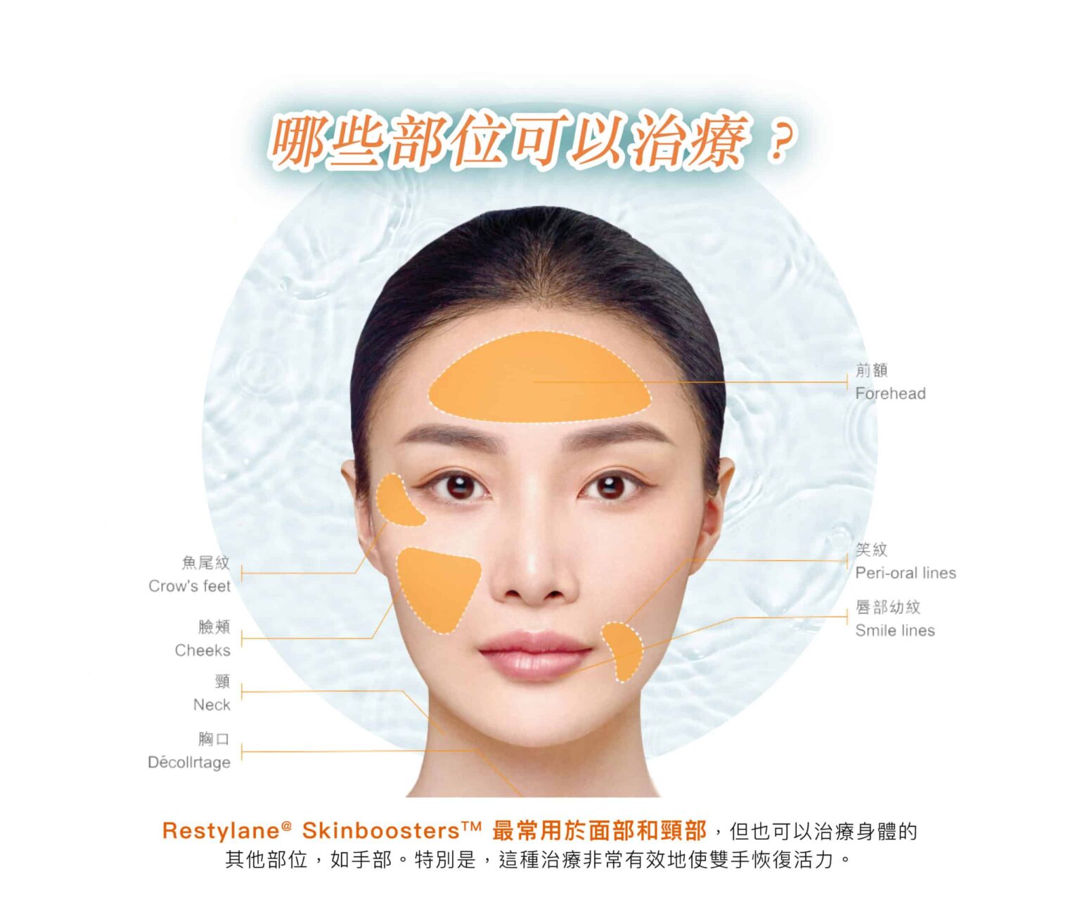 restylane