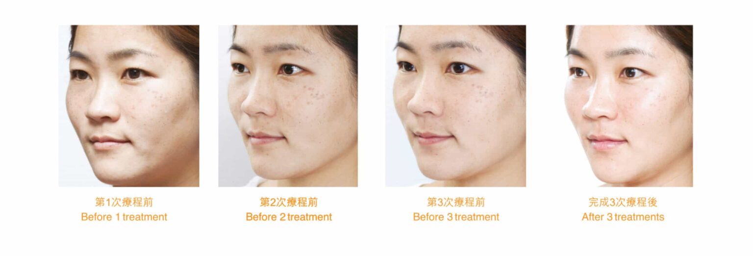 restylane
