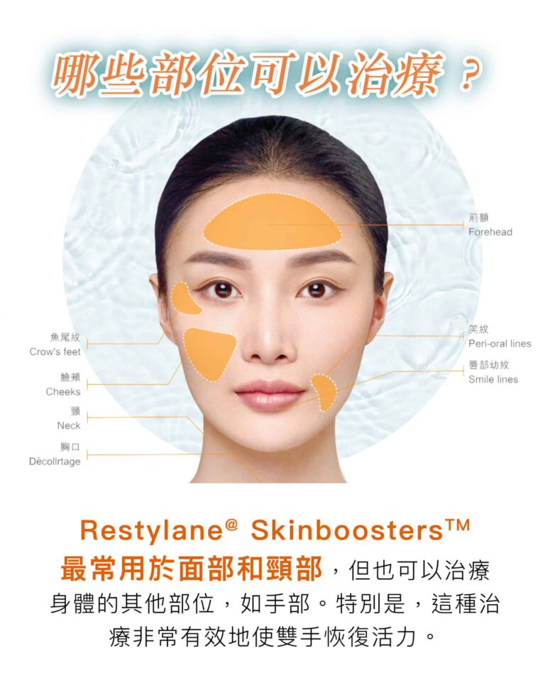 restylane