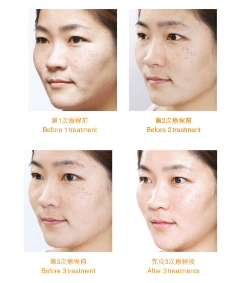 restylane