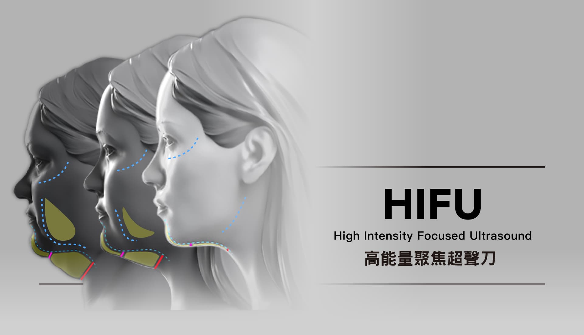 Hifu Q+