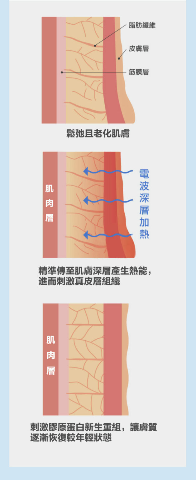 Hifu Q+ Hifu Q+