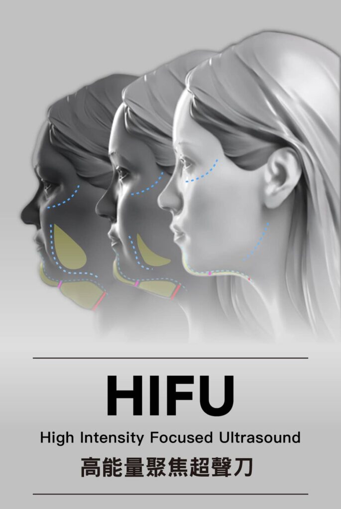 Hifu Q+ Hifu Q+
