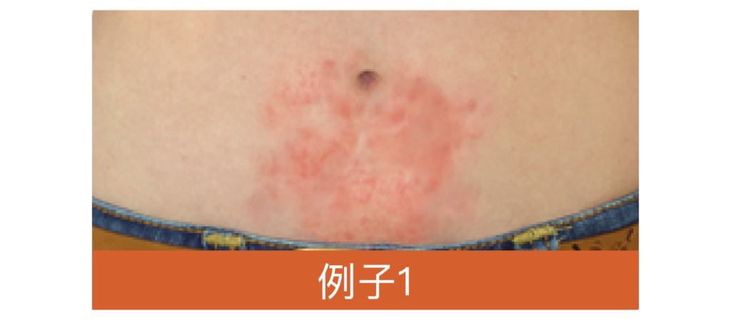 eczeme_and_allergy