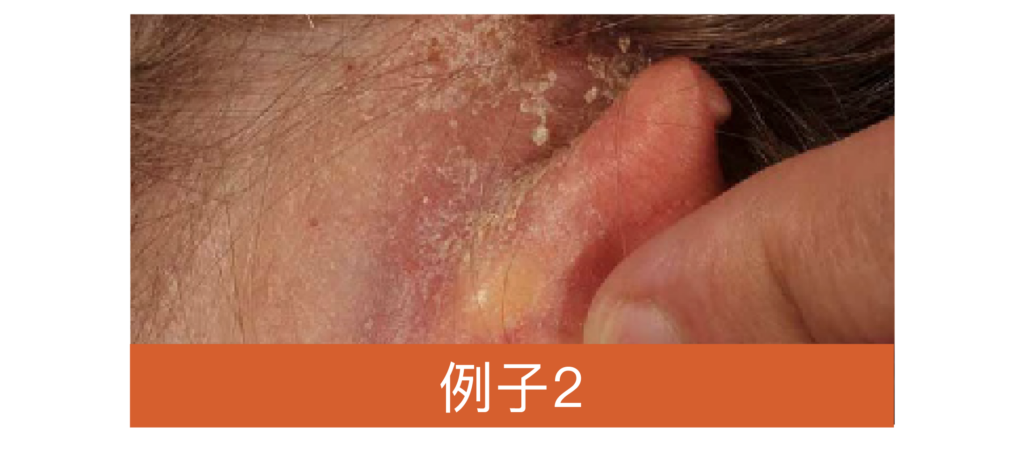 eczeme_and_allergy