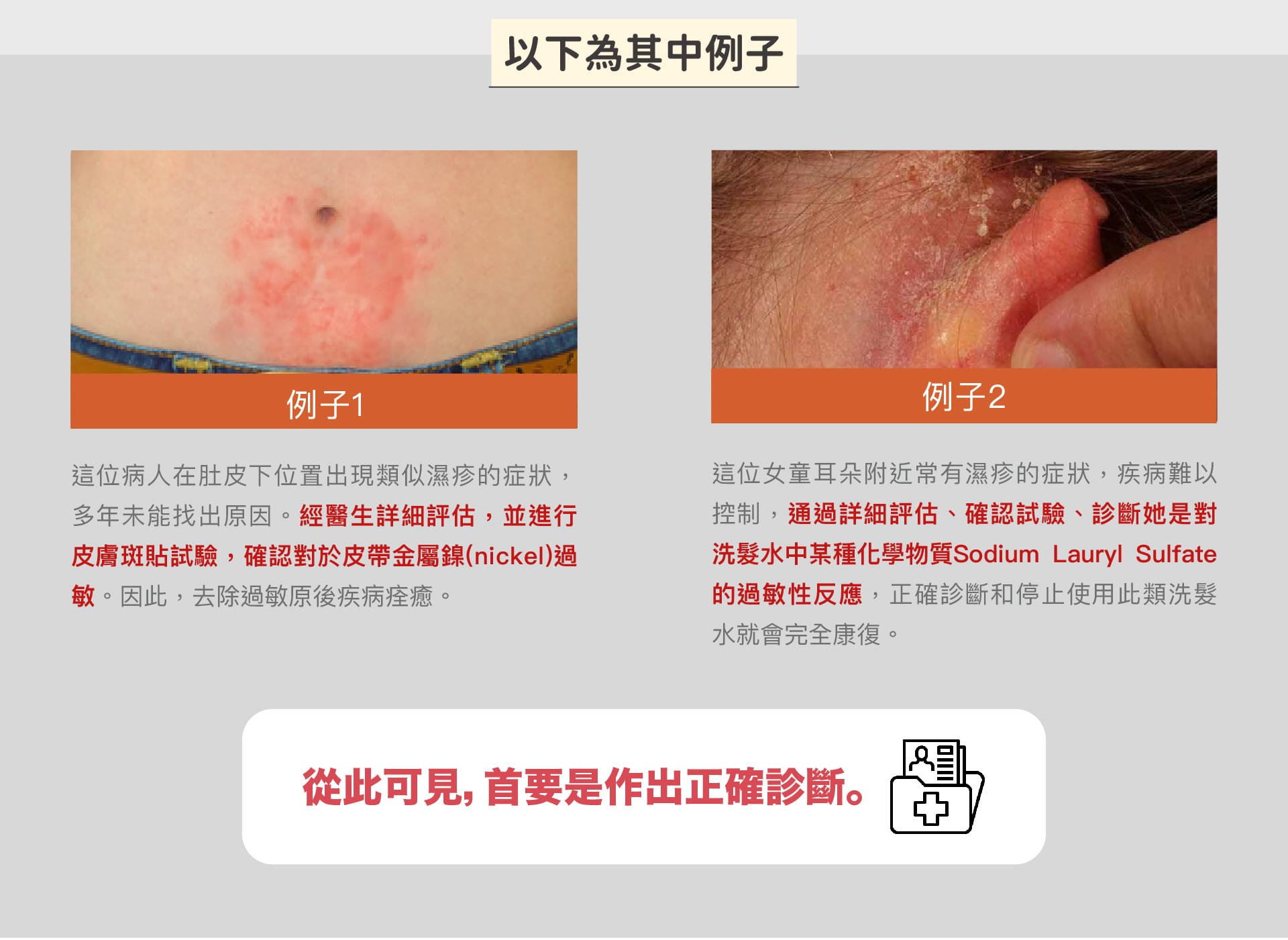 eczeme_and_allergy