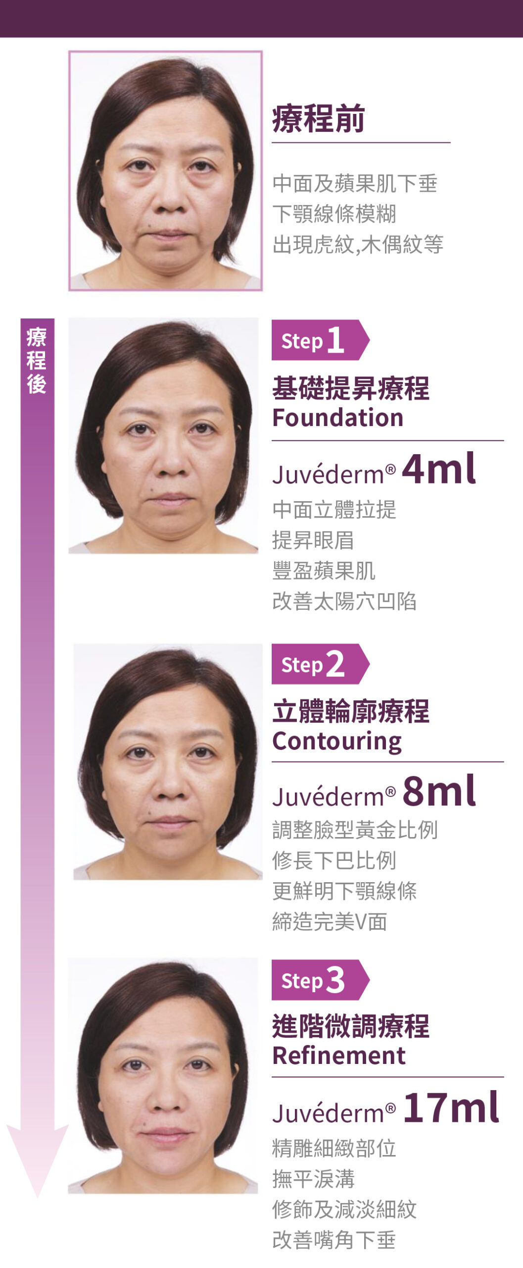 Juvederm
