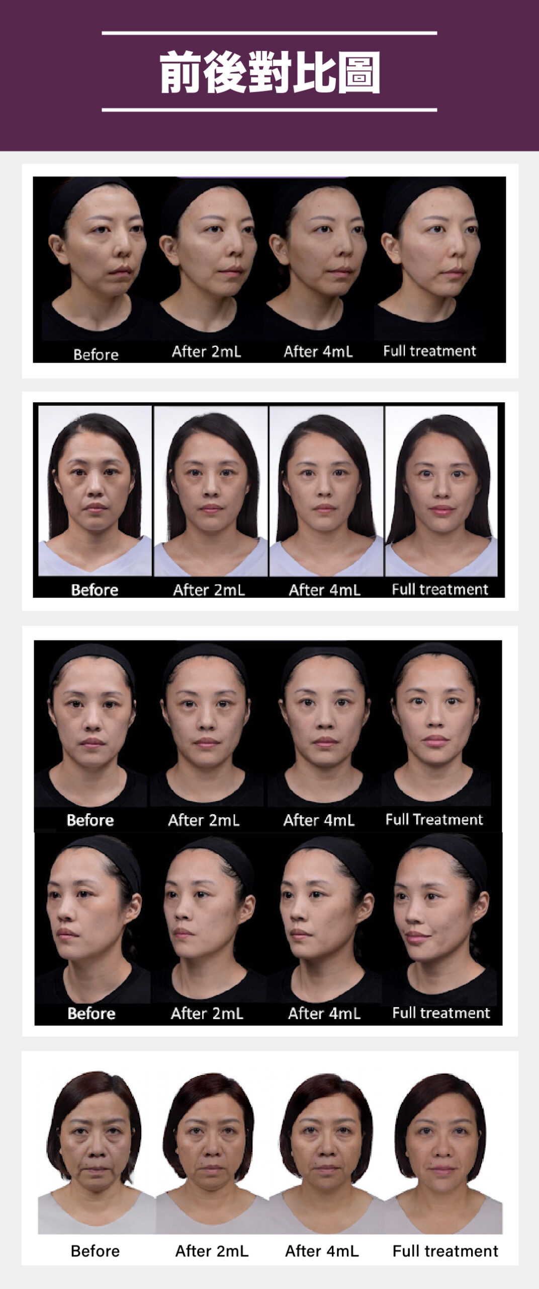 Juvederm