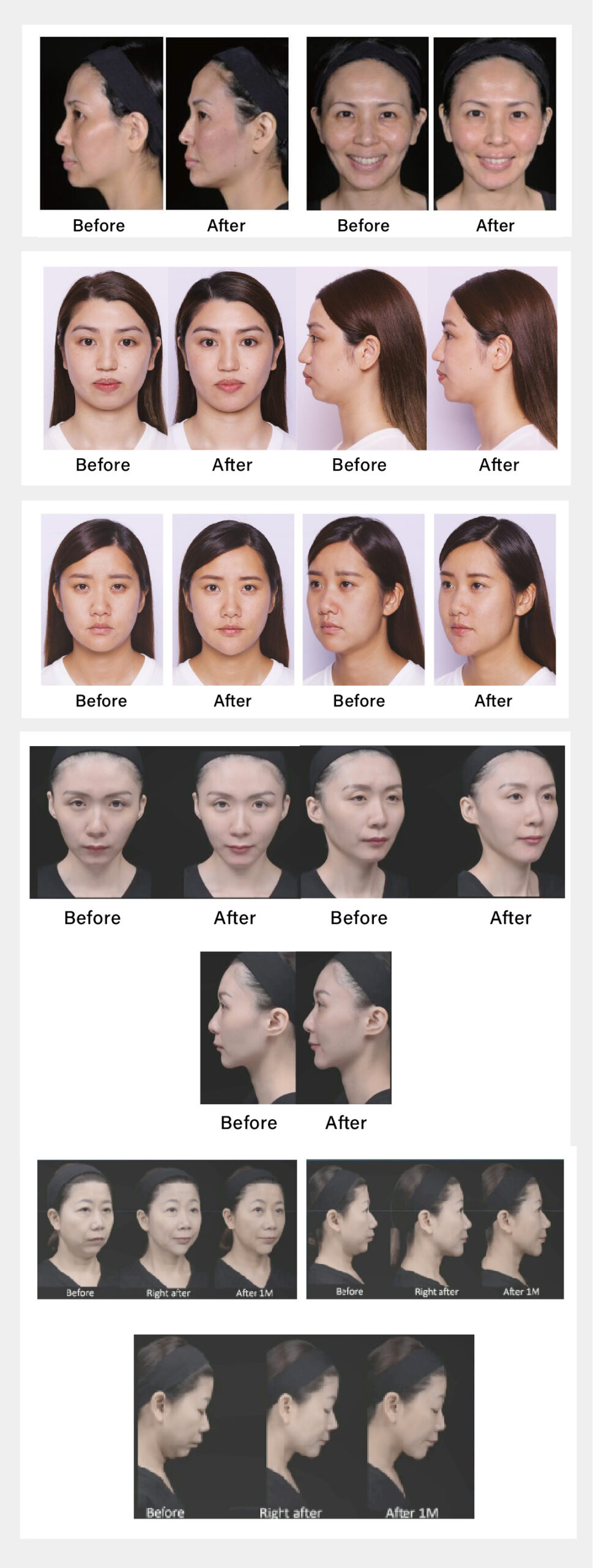Juvederm