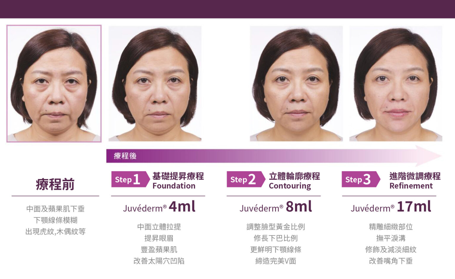 Juvederm