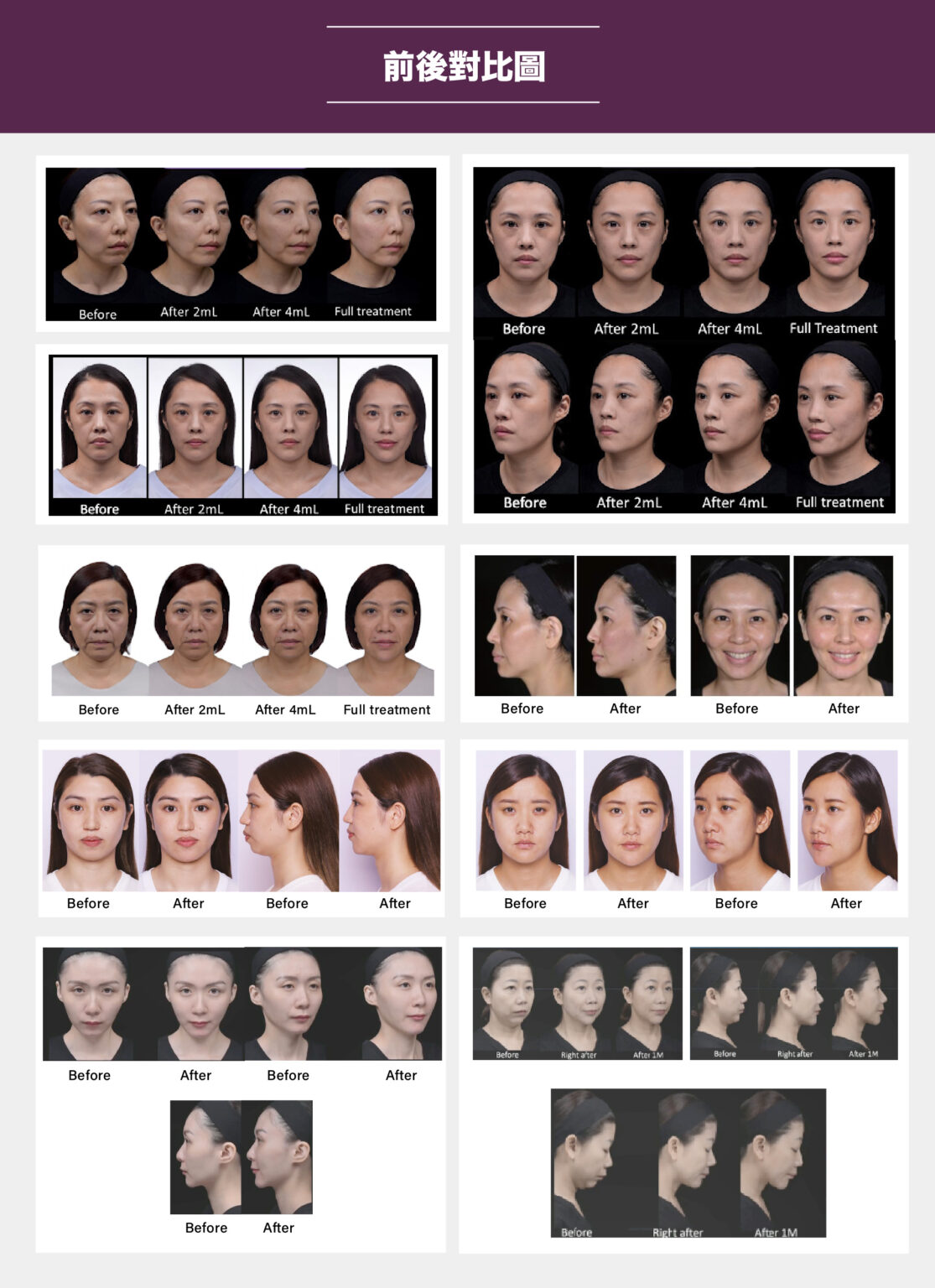 Juvederm