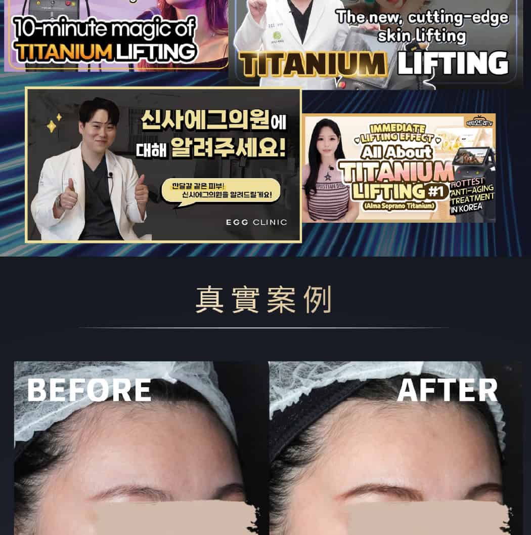 韓國明星級皮膚管理療程Titanium Lifting 最新一代鈦提升