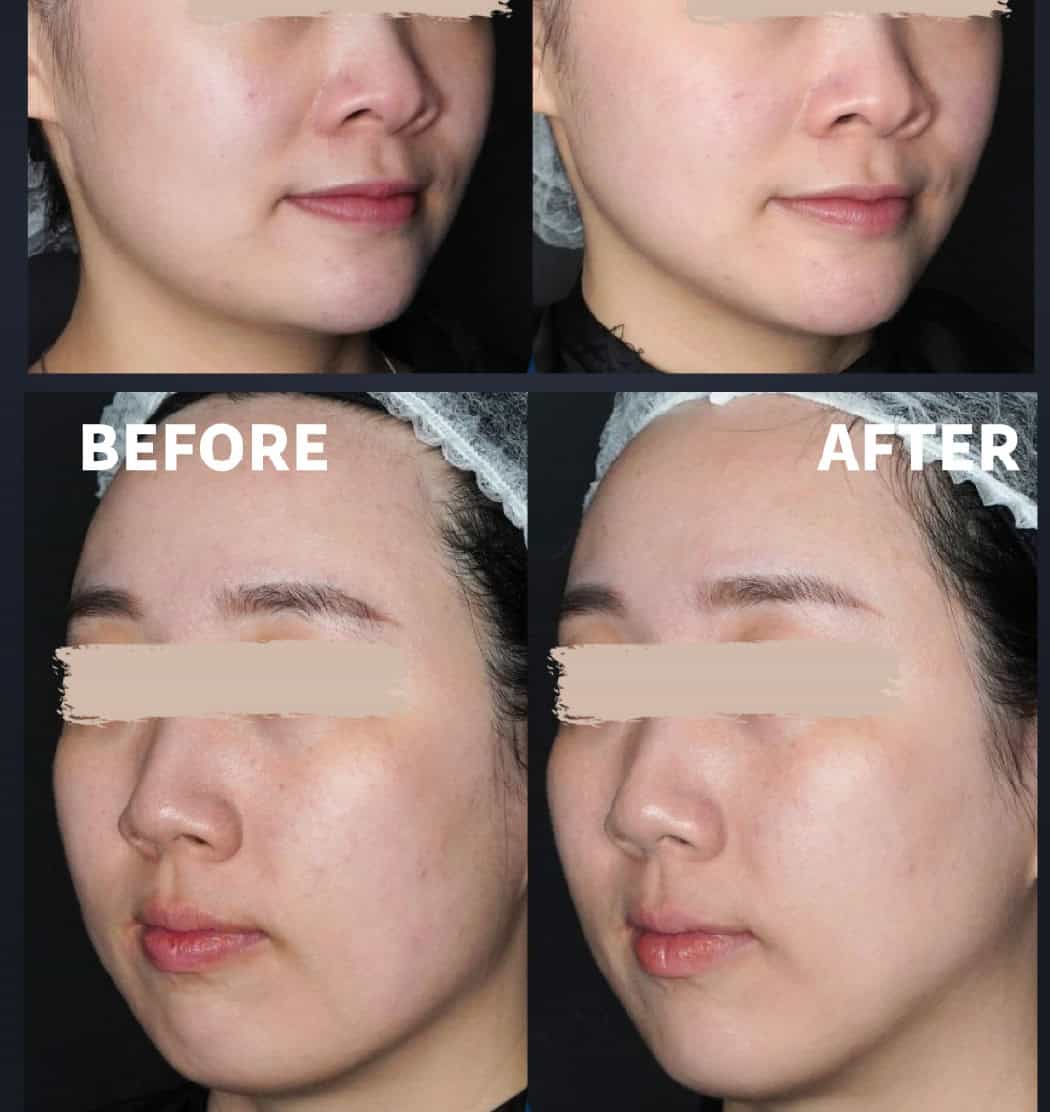 韓國明星級皮膚管理療程Titanium Lifting 最新一代鈦提升