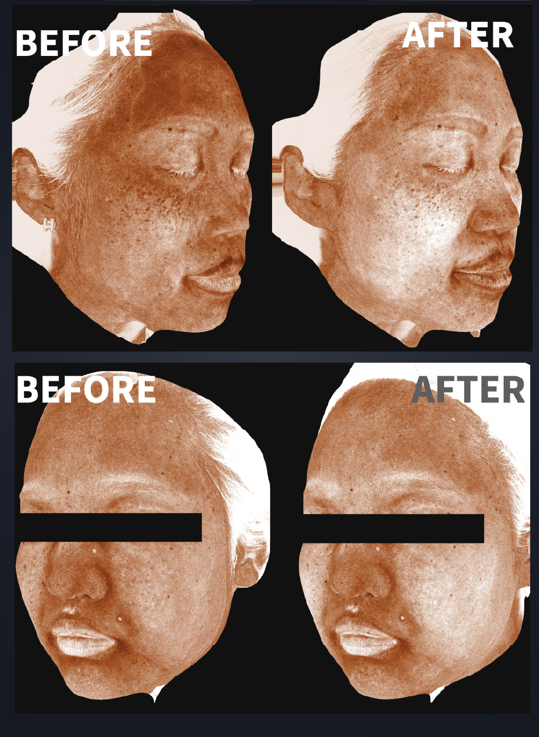 韓國明星級皮膚管理療程Titanium Lifting 最新一代鈦提升